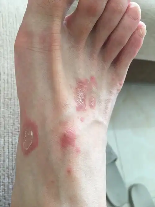 这长的是什么,不痛不痒.梅毒还是艾滋病