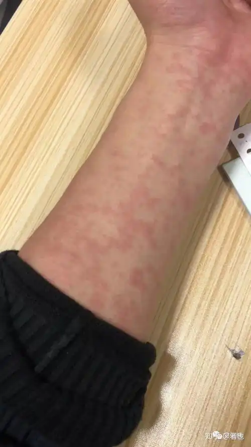 如何区分湿疹和艾滋病