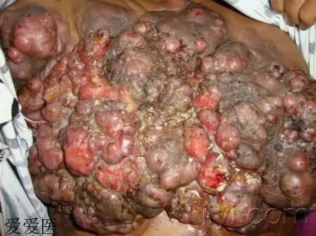 难得糊涂乳腺癌皮肤转移