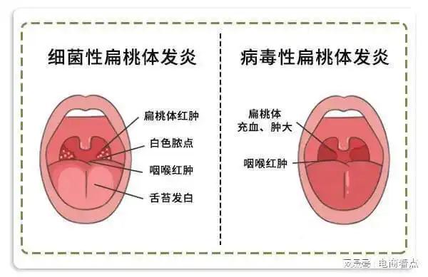 成都哪个医院治疗扁桃体炎最好民生耳鼻喉医院咋样国家三级医院
