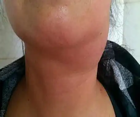 淋巴结肿大图片_淋巴结肿大症状表现图片大全_有来医生