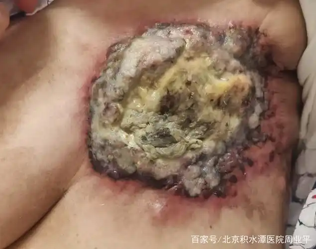 放疗后乳腺癌伤口