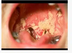 如图所示,目前认为艾滋病患者引起的口腔毛状白斑与何种病毒复制有关