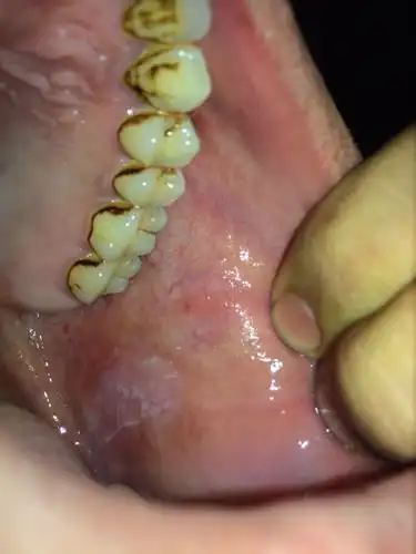 发现嘴巴里面有个这样的白色的东西,是什么?