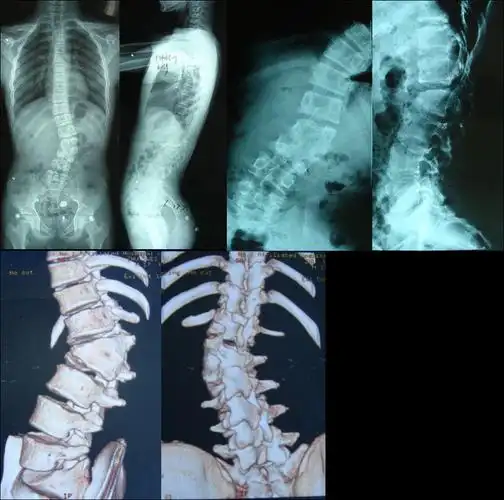 先天性脊柱侧弯2半椎体畸形