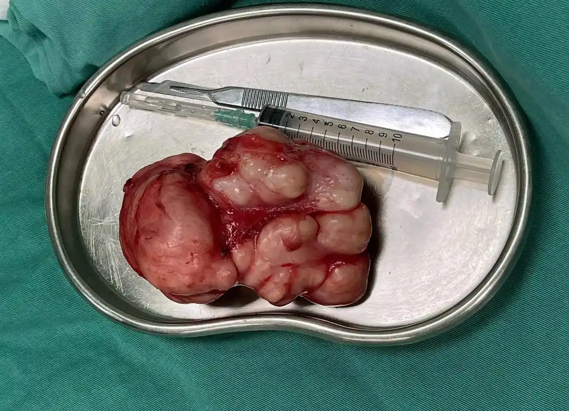 不就个乳腺癌结节手术么,死不了就得自己动手, 接下来就是离婚 - 抖音