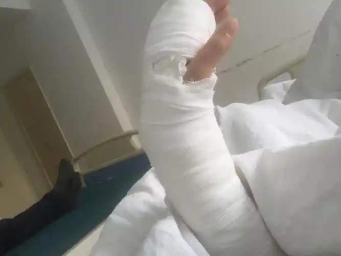 复复位后位石石膏固定,现现在已经四周.可可以拆除石膏吗?